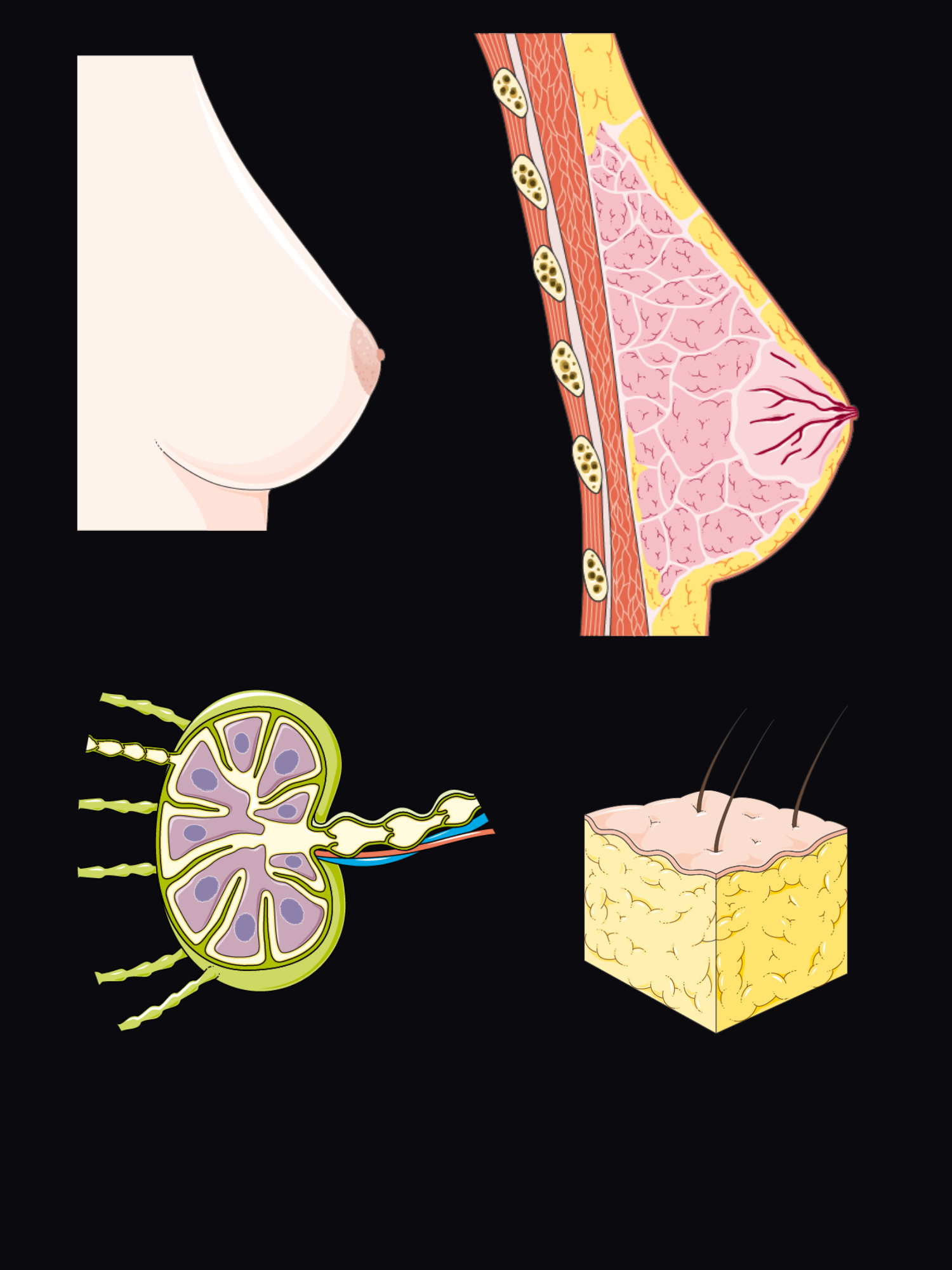 Exploded view of the breast: the breast from the outside, the breast in sagittal section showing lobules, ducts and fat over the pectoralis and ribs, an axillary lymph node in section, and a block of fatty stroma.